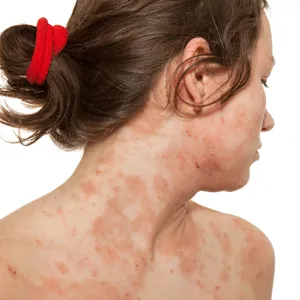 Eczema