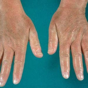 Contact Dermatitis