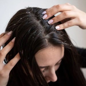 Dandruff