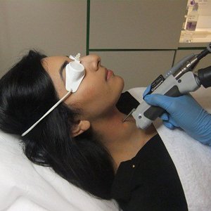 Laser Hair Reduction 