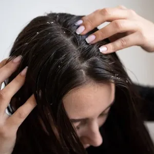 Dandruff