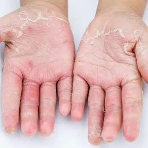 Photosensitive Dermatitis