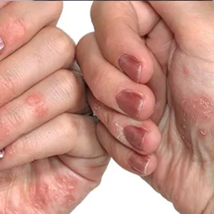 Psoriasis