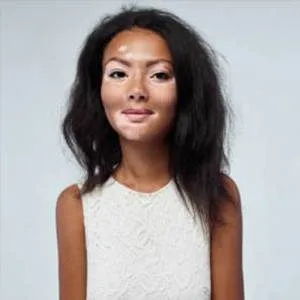Vitiligo 